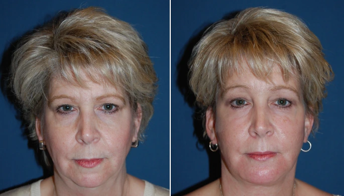 Category IV Brow Lift before and after photo, front view, by Dr. Sean Freeman in Charlotte, NC