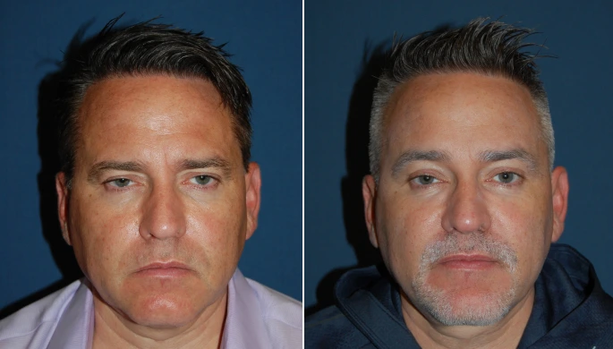 Category V Brow Lift before and after photo, front view, by Dr. Sean Freeman in Charlotte, NC