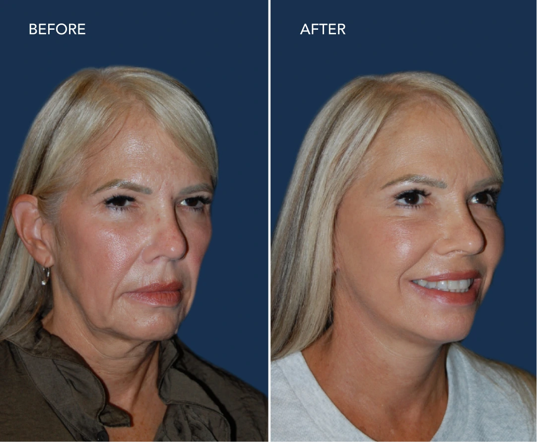 Before and after facial rejuvenation showing smoother skin texture and enhanced smile