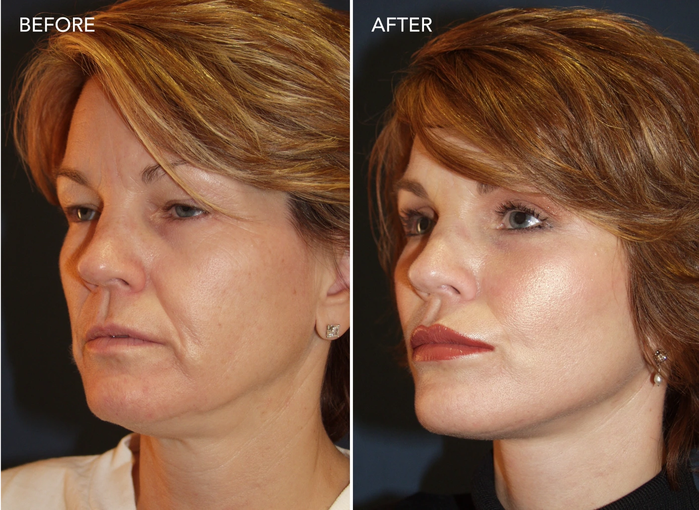 Before and after profile view showing facial rejuvenation with enhanced definition and improved skin appearance
