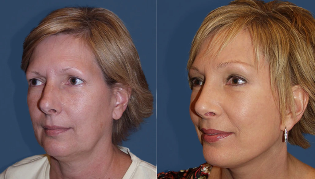 Woman's face in profile before and after facial enhancement, showing improved cheek and jawline definition