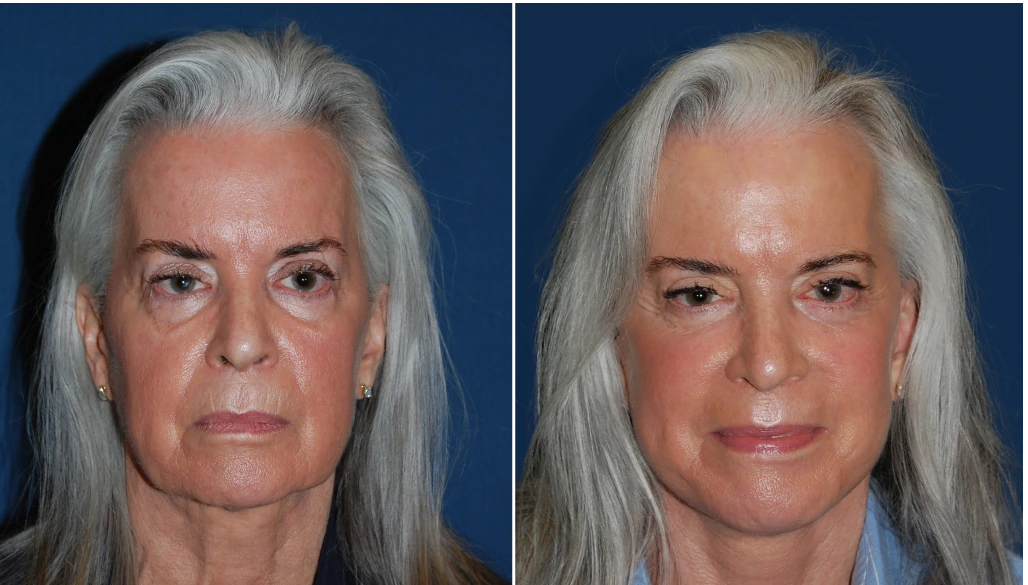 Older woman's face before and after facial treatment, showing improved skin tone and reduced forehead lines