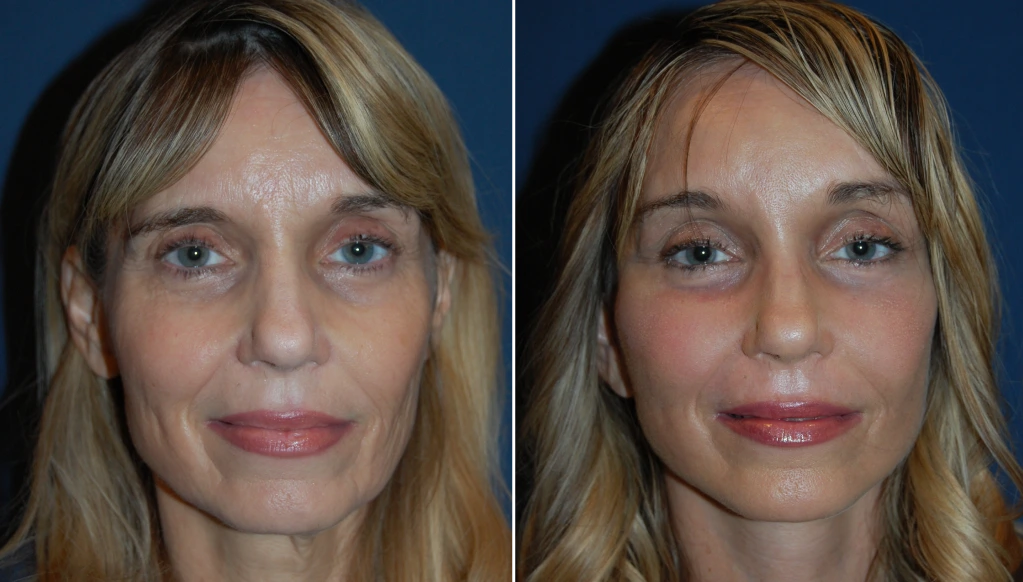 Woman's face before and after facial rejuvenation treatment, showing refined facial contours and skin quality