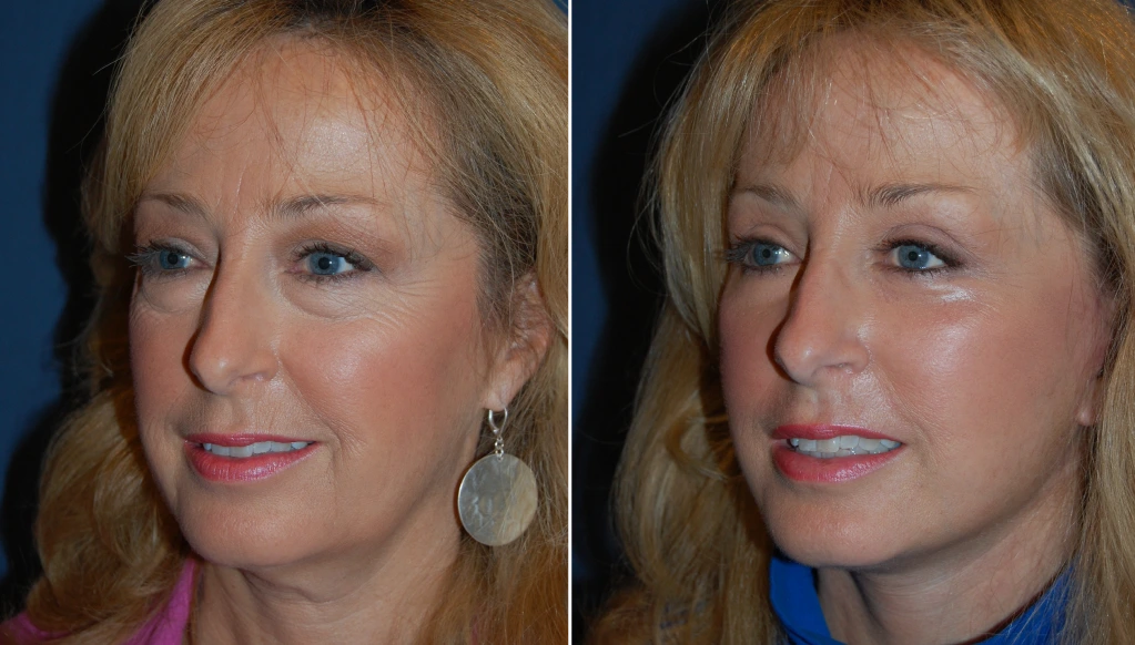 Woman's face in profile before and after facial aesthetic treatment, showing improved skin texture and definition