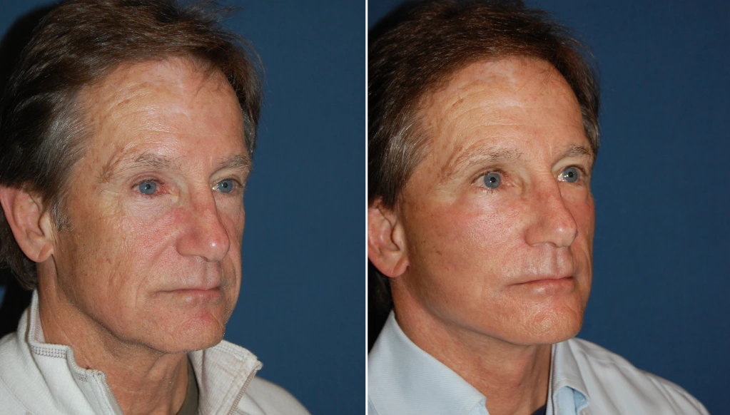 Before and after side profile showing reduction in facial wrinkles and skin texture improvement