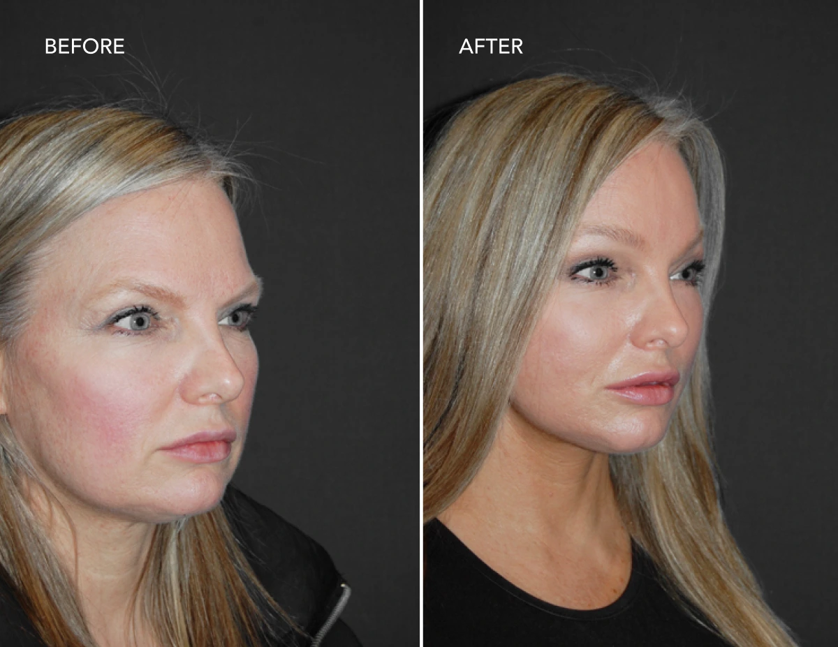 Before and after profile view showing patient's chin and jawline definition improvement