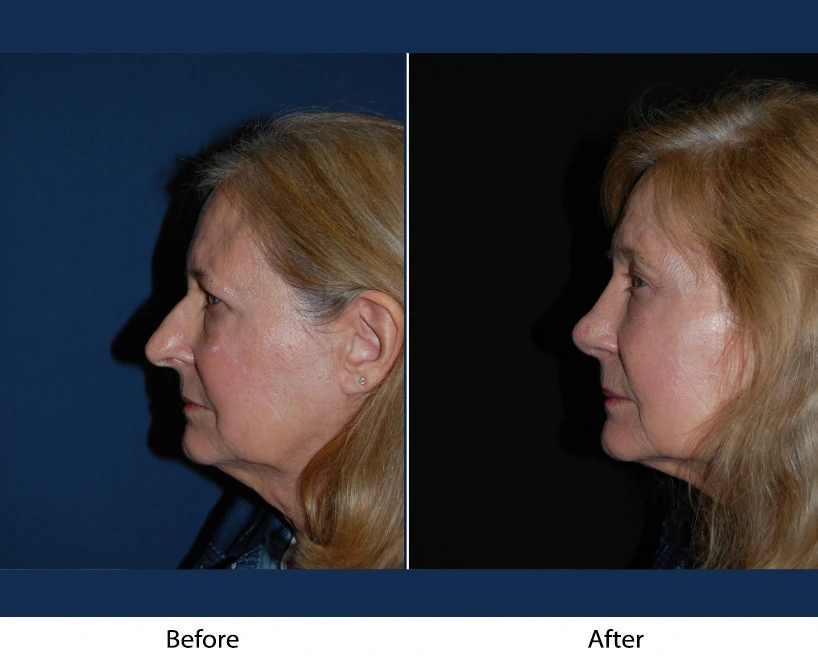 Before and after profile views of woman's face and neck showing facial changes