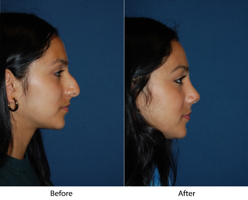 Before and after rhinoplasty, side profile showing refined nose shape and improved facial proportion