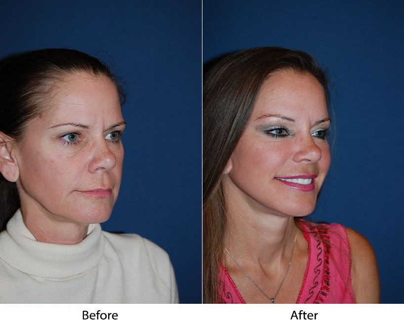 Side profile comparison: woman before and after facelift showing improved facial contours