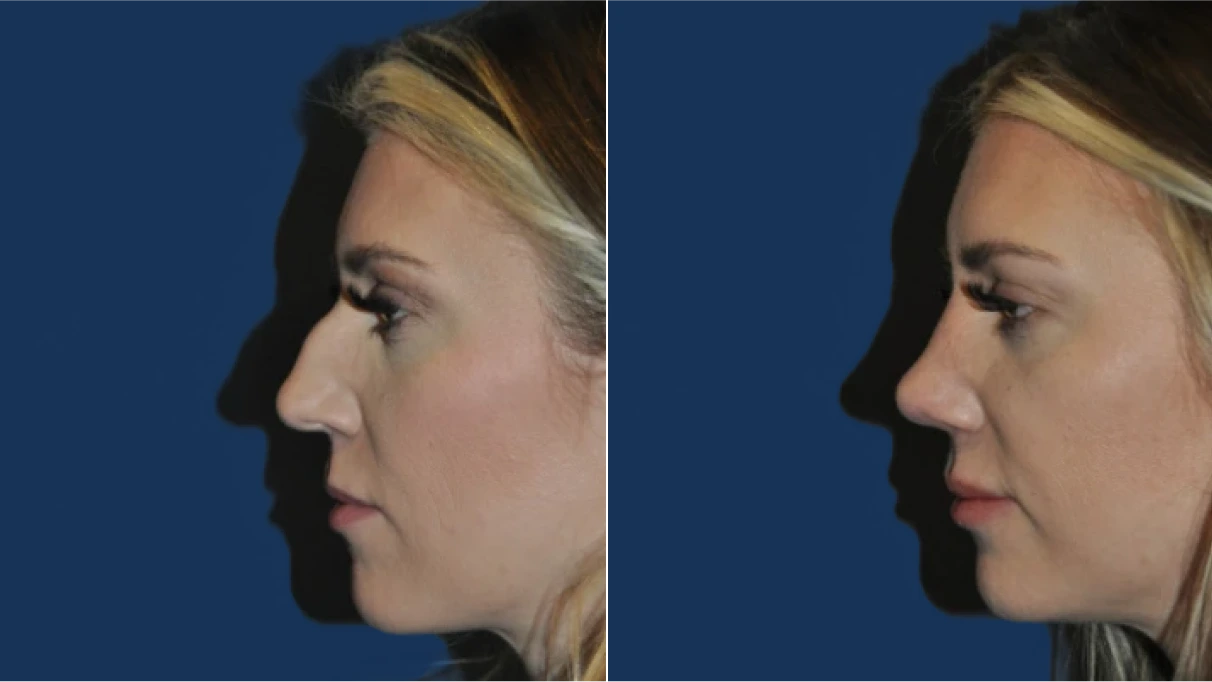 Before and after profile views of chin augmentation results