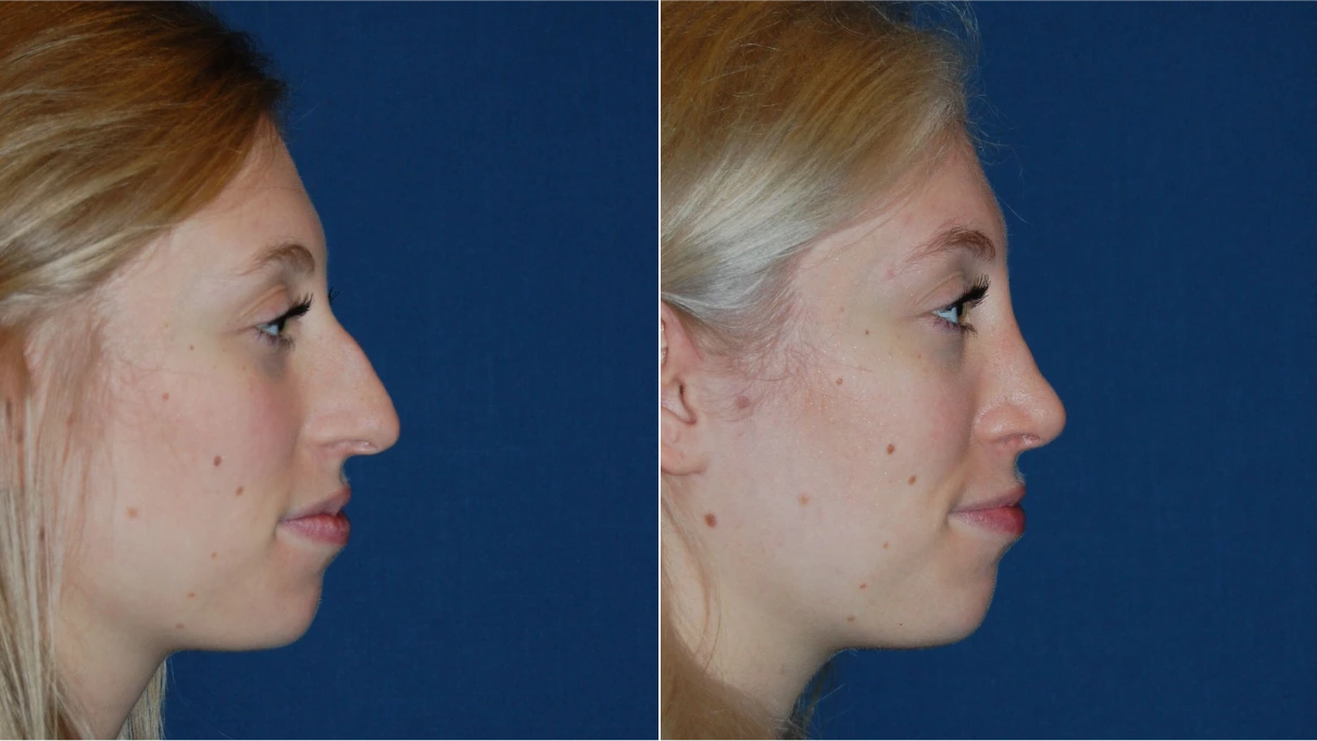 Before and after profile facial photos showing chin and jawline definition changes