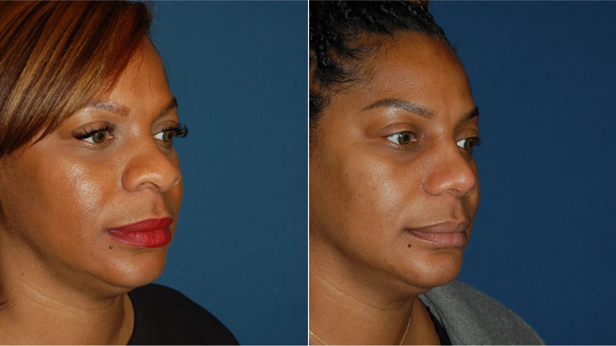 Before and after profile facial photos showing facial contour changes