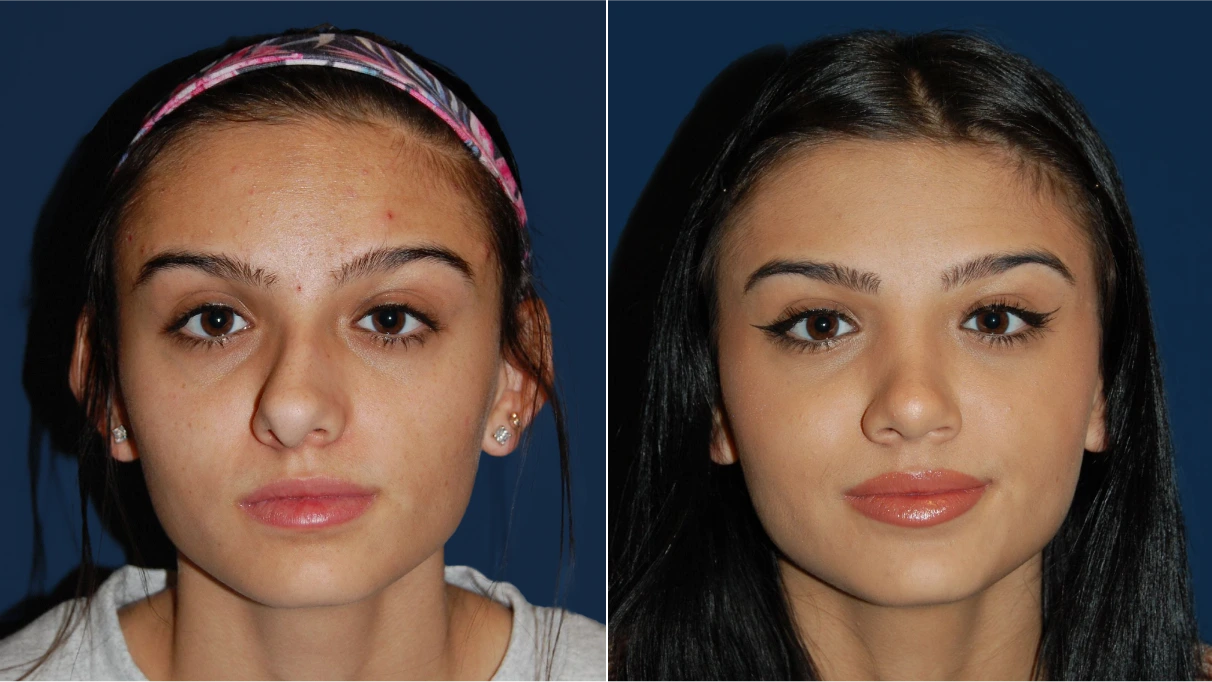 Before and after frontal facial photos showing skin texture and appearance changes