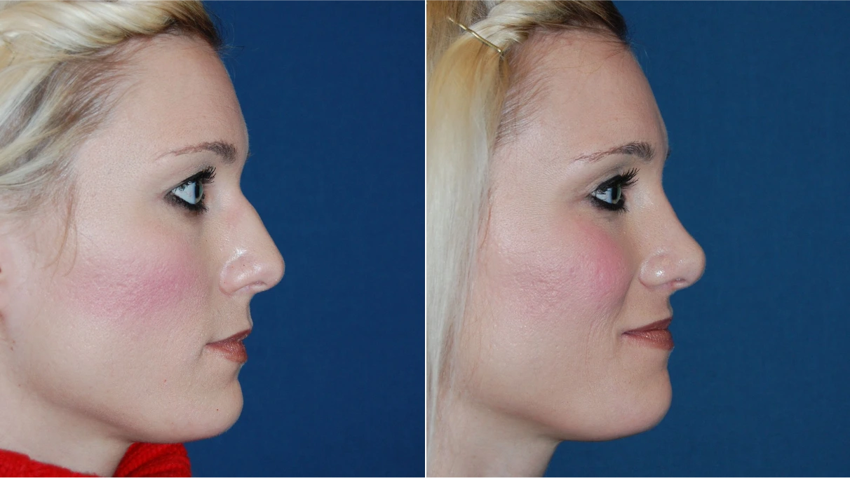Before and after profile views showing results of chin implant surgery