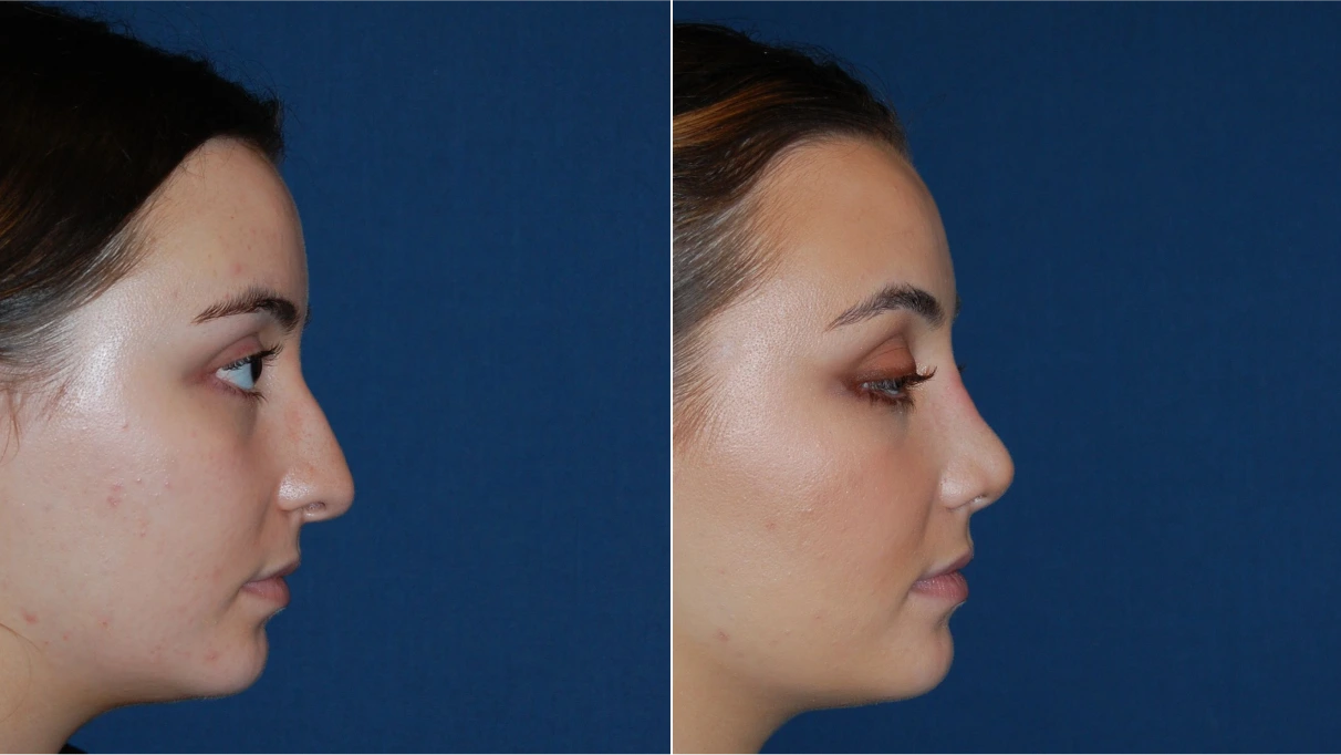 Before and after side profile comparison of rhinoplasty procedure