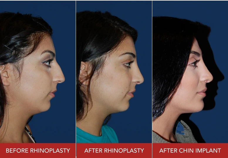 Before rhinoplasty, after rhinoplasty, and after chin implant side profile comparisons