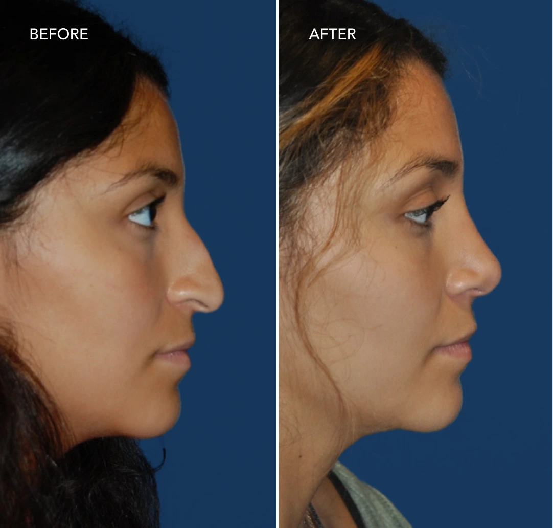 Side-by-side profile comparison labeled Before and After showing facial contour changes
