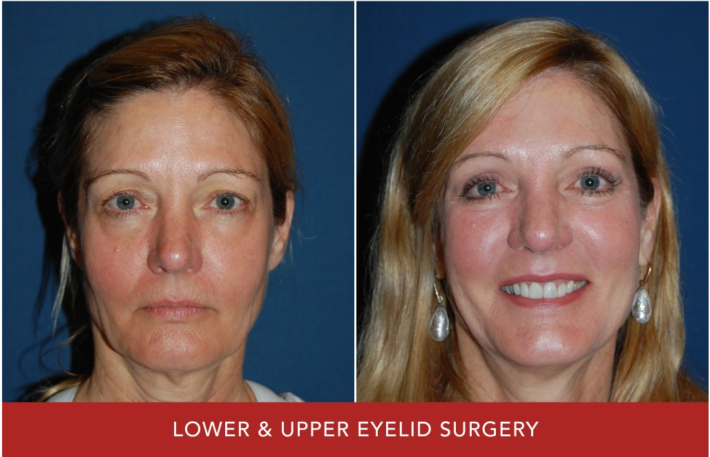 Before and after lower and upper eyelid surgery, frontal view showing reduced puffiness and lifted appearance