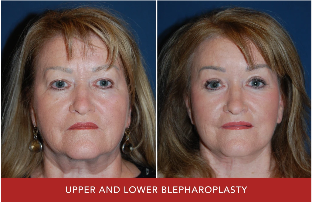 Before and after upper and lower blepharoplasty showing woman with improved eyelid appearance