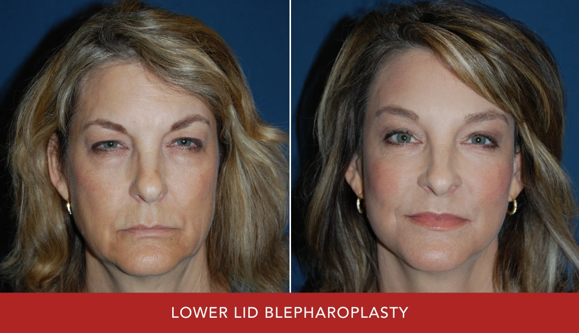 Before and after lower lid blepharoplasty showing woman with tighter lower eyelids