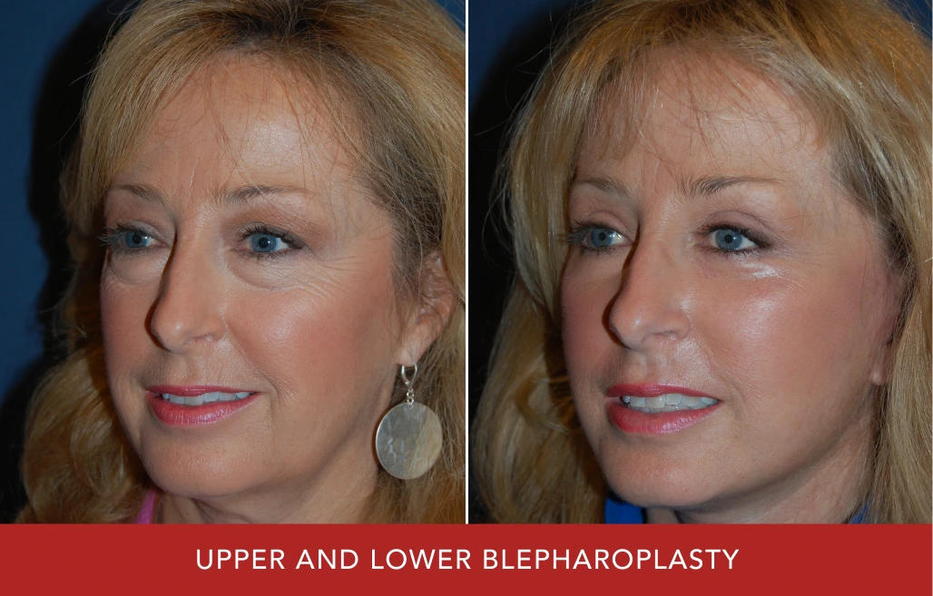 Before and after upper and lower blepharoplasty showing woman with lifted, more youthful eyes