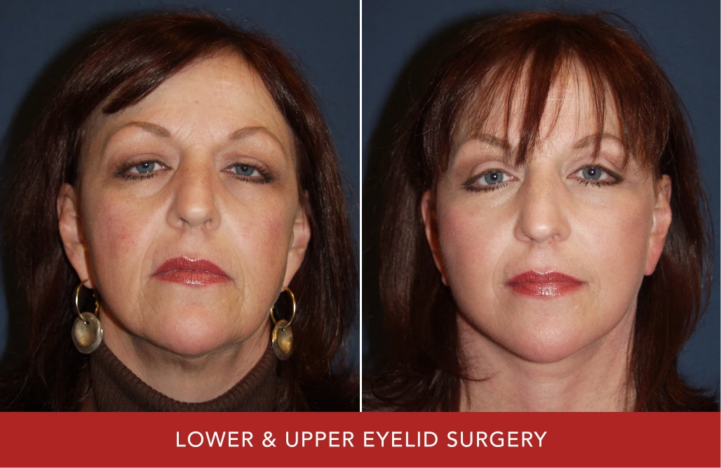 Before and after lower and upper eyelid surgery showing woman with more defined eye contour
