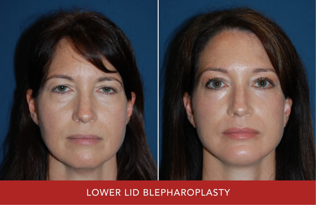 Before and after lower lid blepharoplasty showing woman with reduced under-eye puffiness
