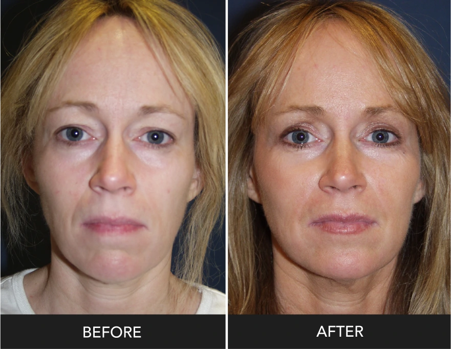 Before and after eyelid surgery, frontal view showing reduced under-eye bags and improved eye contour
