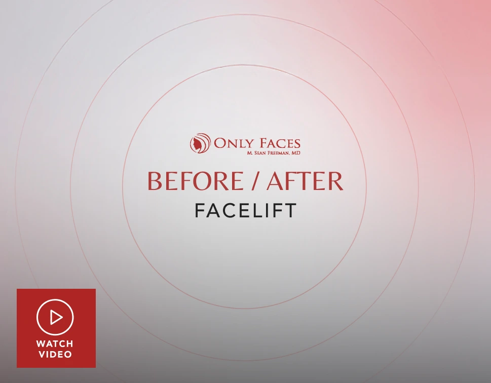 Only Faces logo with text "Before / After Facelift" and red play button labeled "Watch Video"