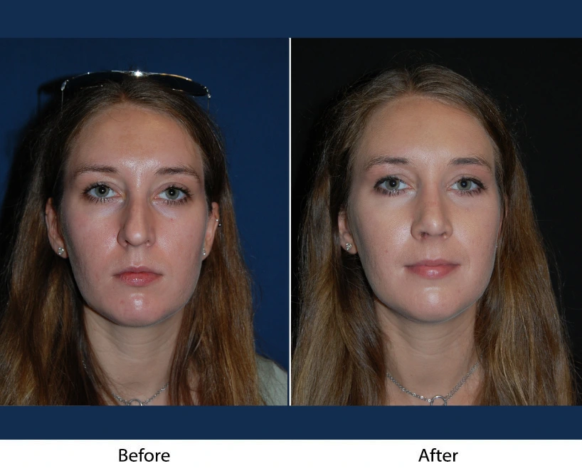 Front-facing comparison: woman before and after cosmetic facial procedure