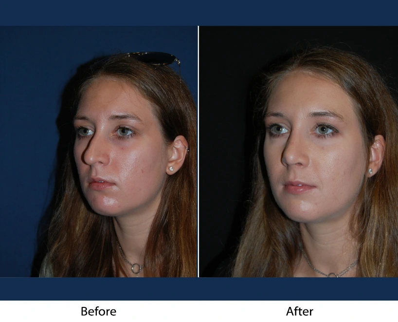 Three-quarter view comparison: woman before and after facial rejuvenation treatment