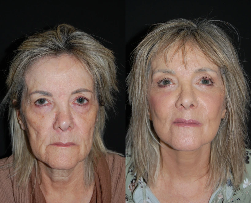 Before and after facial comparison showing woman's face from front view, demonstrating skin texture and appearance changes