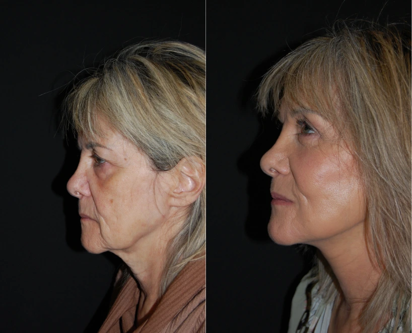 Before and after profile views of a patient showing facial rejuvenation results
