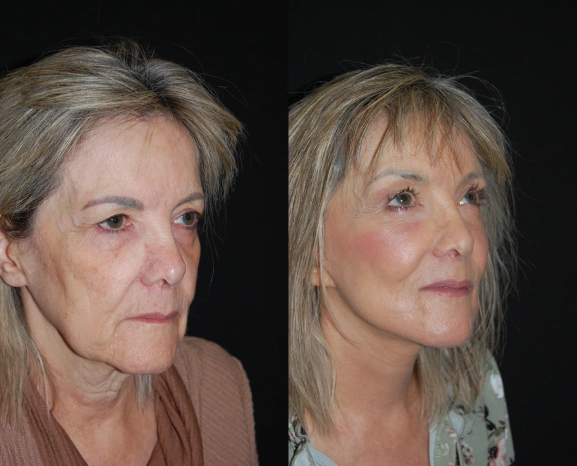 Before and after facial profile views showing improved skin texture and facial contours