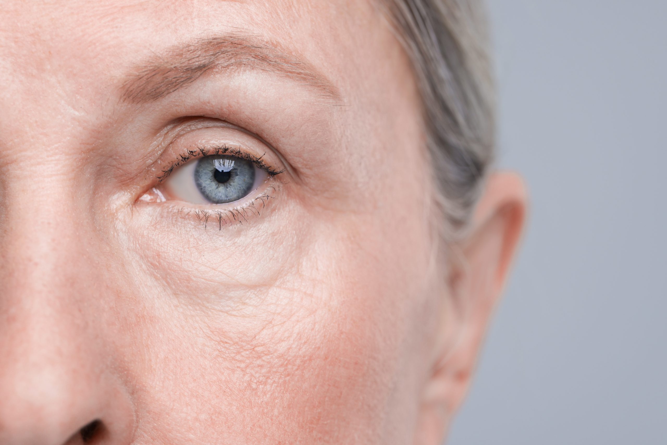 Who Is a Good Candidate for Lower Blepharoplasty? Banner