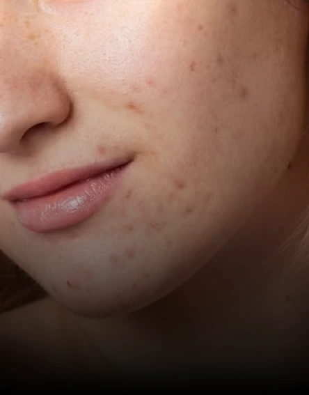 Close-up of person's cheek showing acne scars and post-inflammatory marks on skin