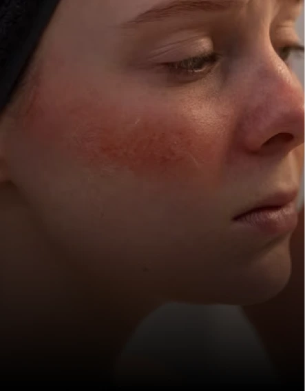 Side profile of person's face with redness and flushing across cheeks and nose
