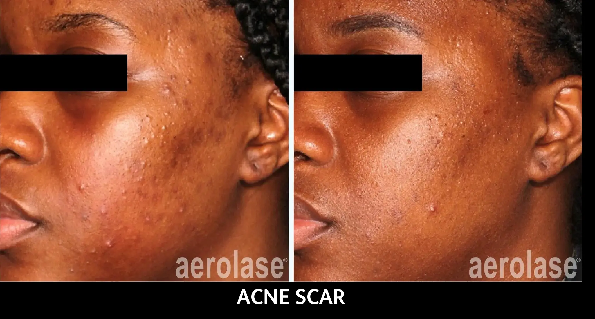 Before and after comparison showing reduced acne scars on cheek with aerolase treatment