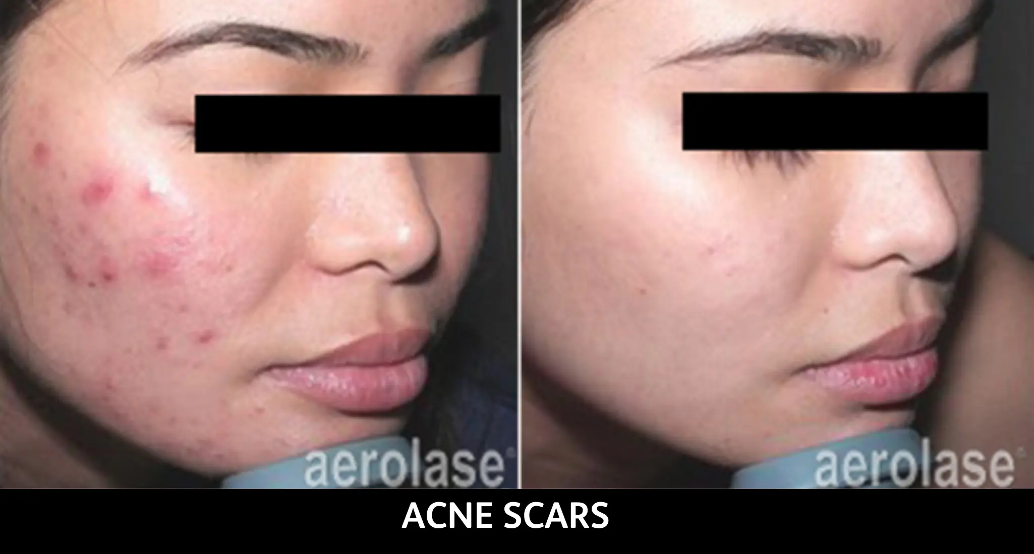 Before and after comparison showing reduced acne and scars on cheek with aerolase treatment