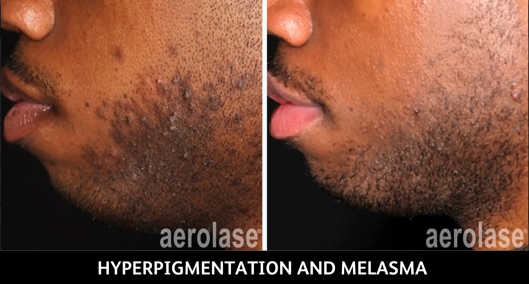 Before and after comparison showing reduced hyperpigmentation and melasma on jawline with aerolase treatment