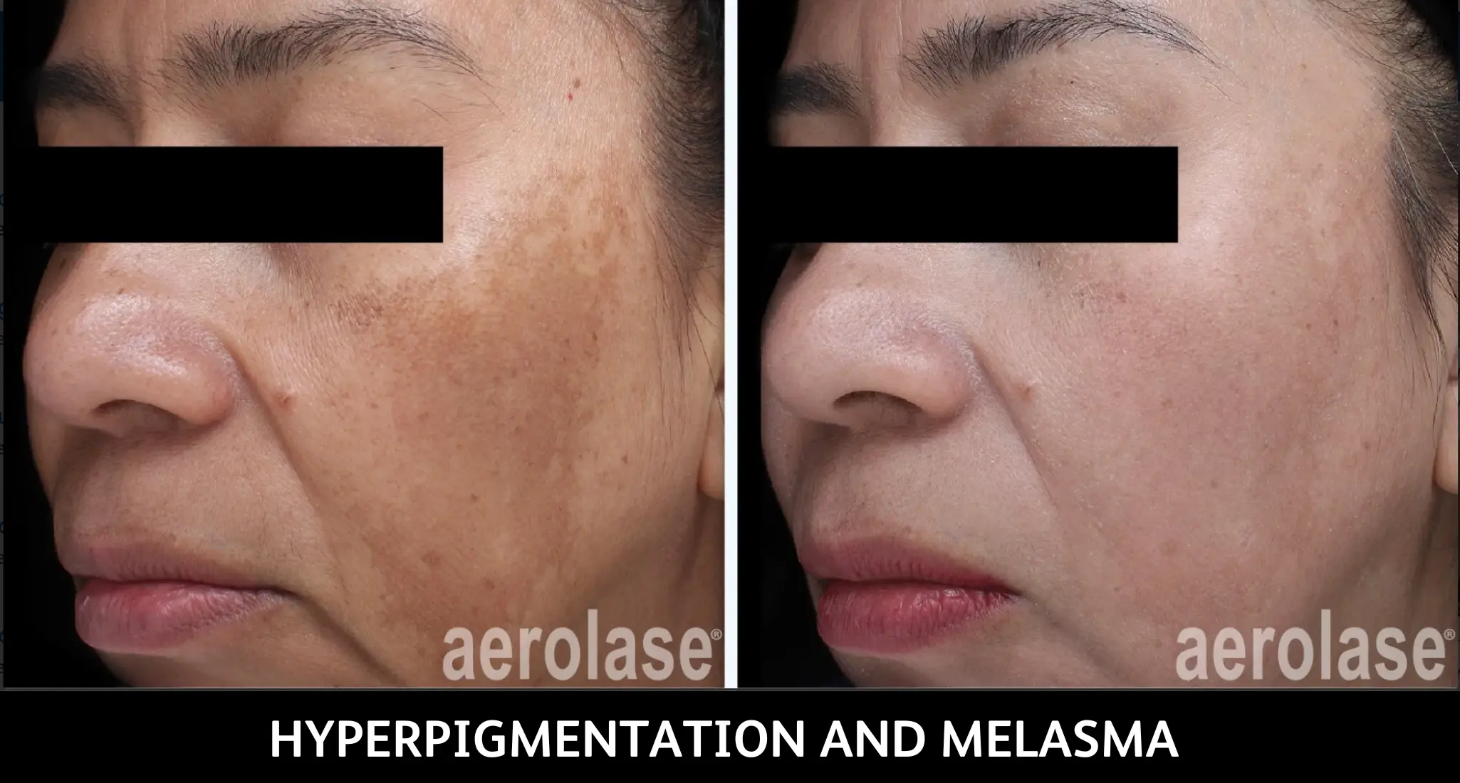 Before and after aerolase treatment for facial hyperpigmentation and melasma, showing reduced brown patches on cheek