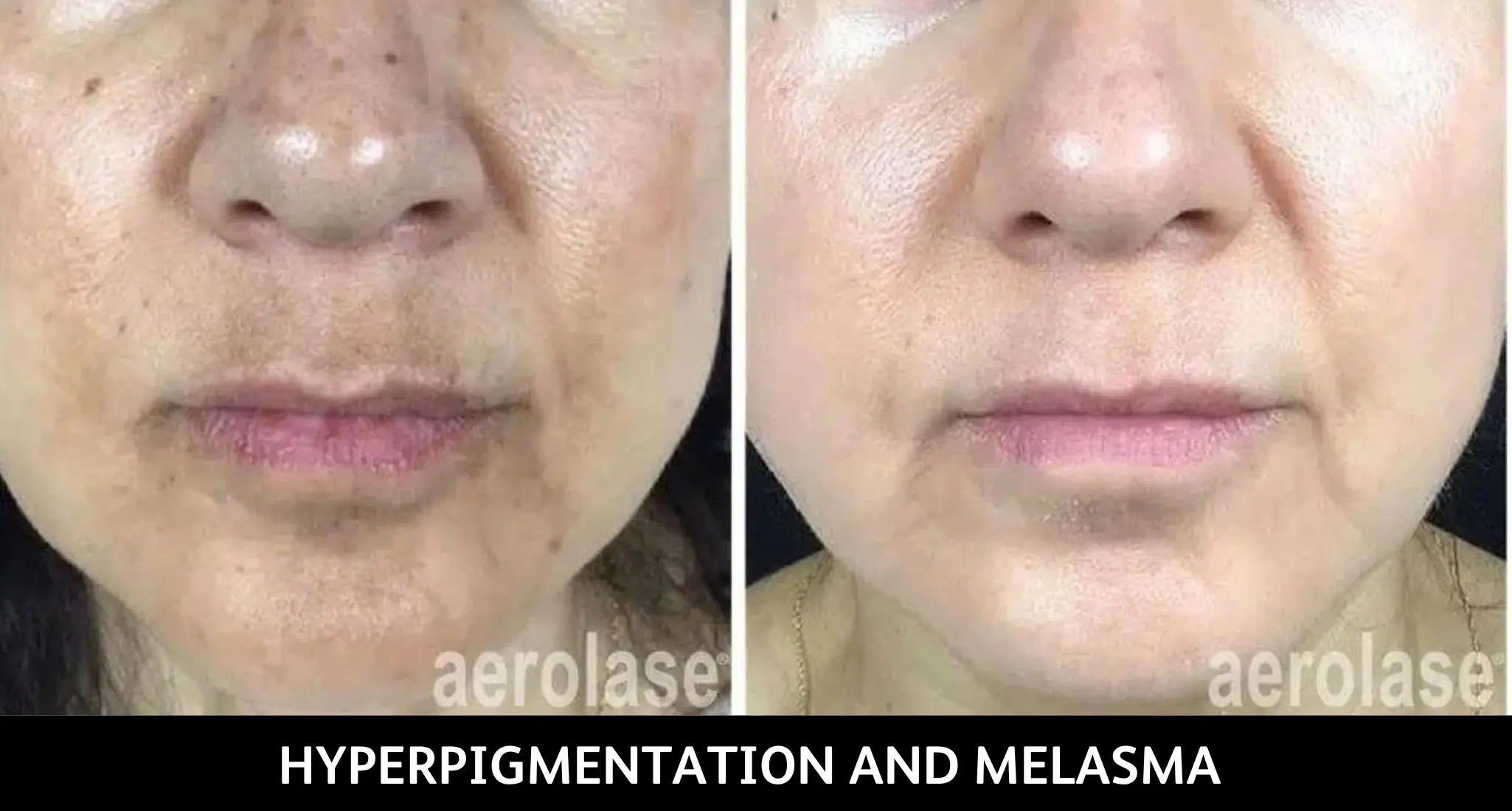 Before and after aerolase treatment for hyperpigmentation and melasma on lower face, showing even skin tone