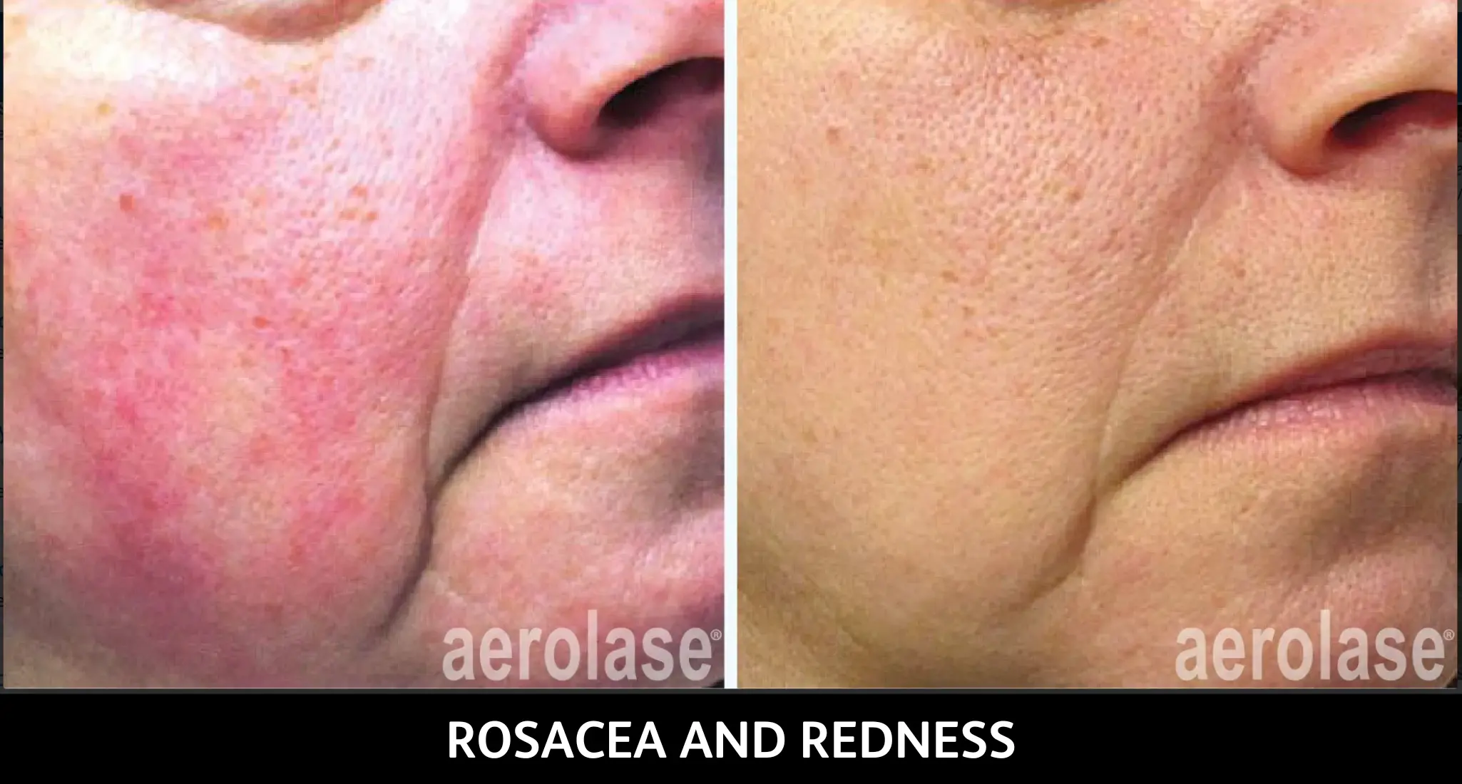 Before and after aerolase treatment for rosacea and redness on cheek, showing reduced flushing