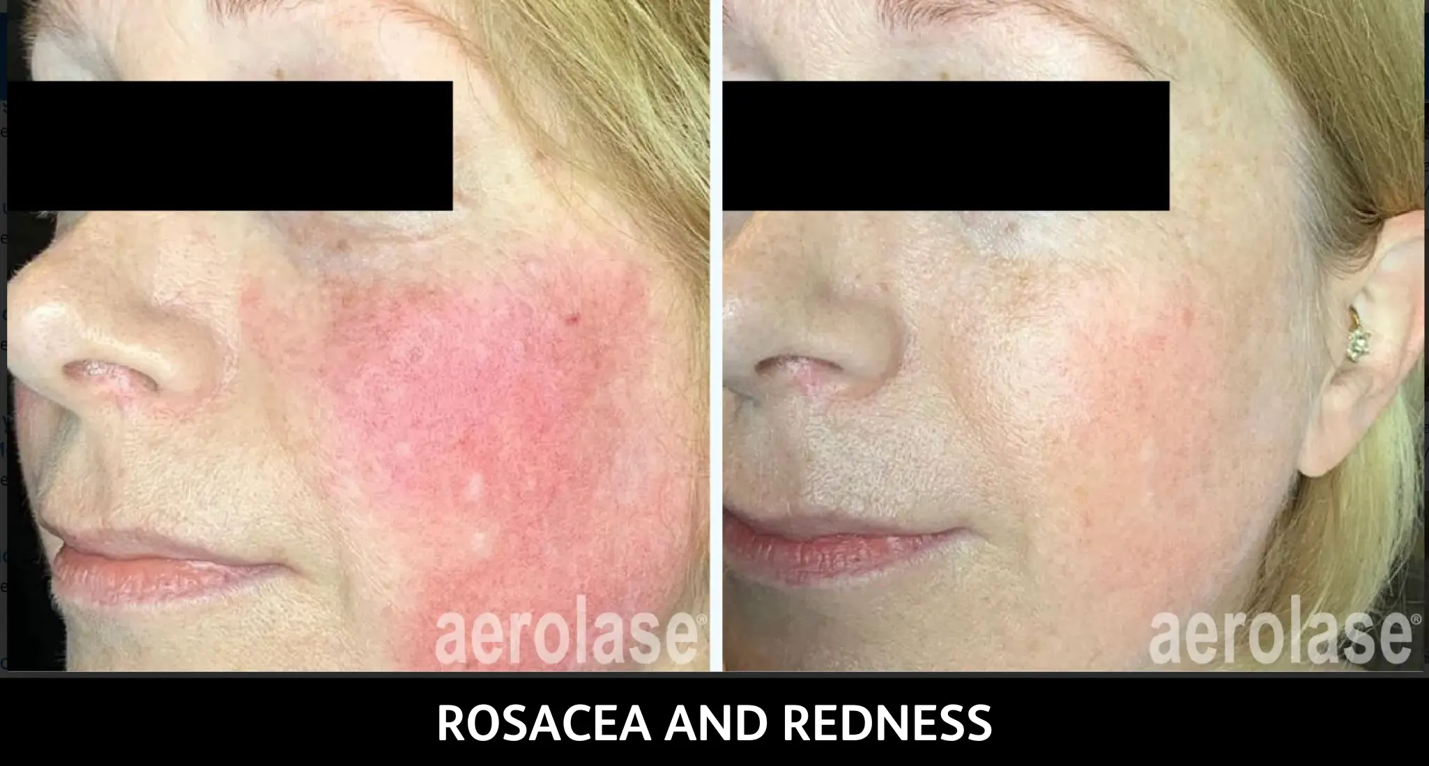 Before and after aerolase treatment for facial rosacea and redness, showing calmer complexion