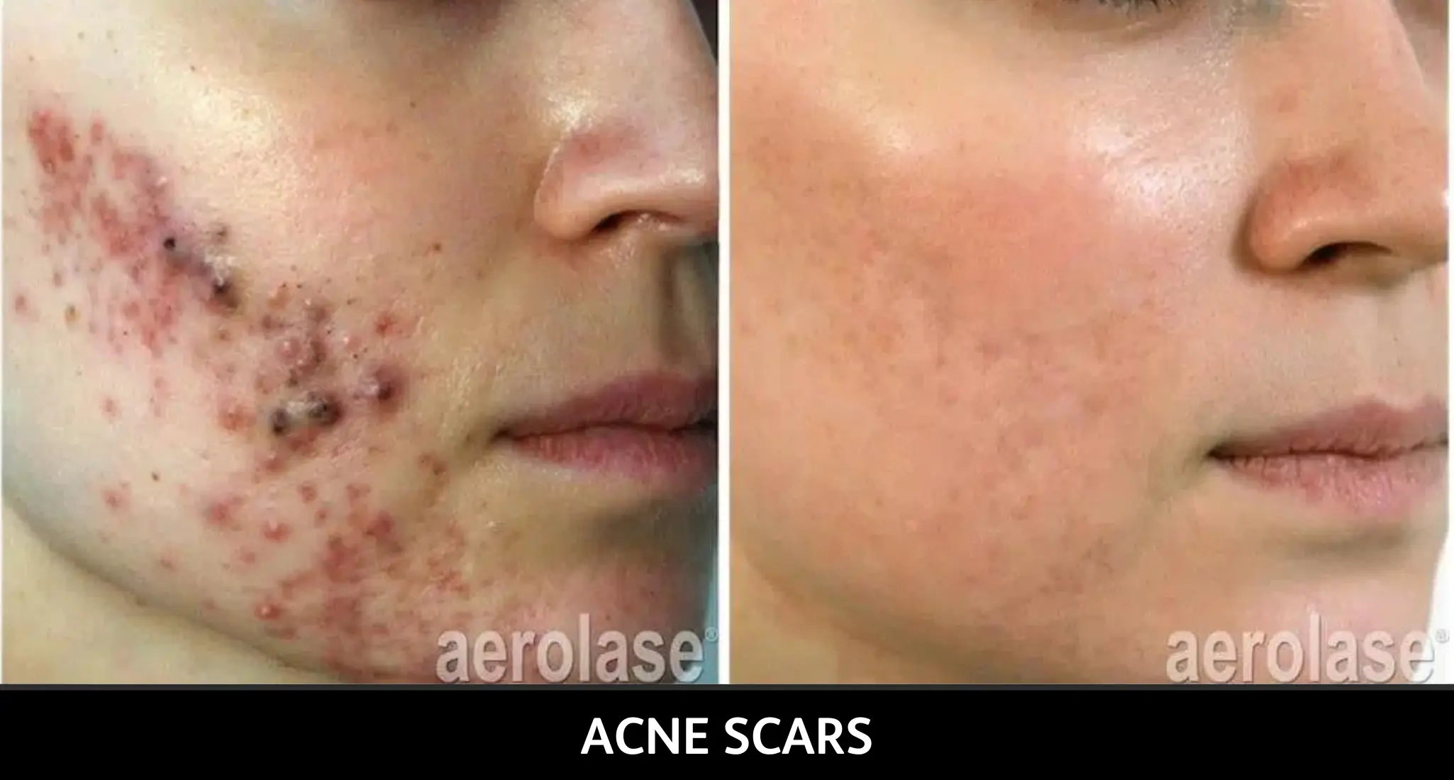 Before and after aerolase treatment for acne scars on cheek, showing smoother skin texture