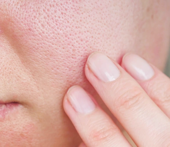 Portland, OR Skin Conditions: Enlarged Pores Banner