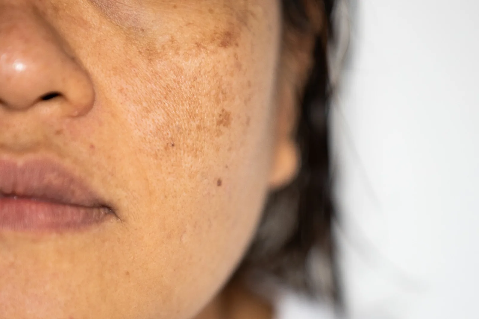 How to Treat Hyperpigmentation: Which Treatments Really Work? banner