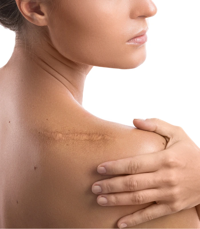 Close-up of a healed vertical surgical scar on a woman’s abdomen, her hands resting on the skin