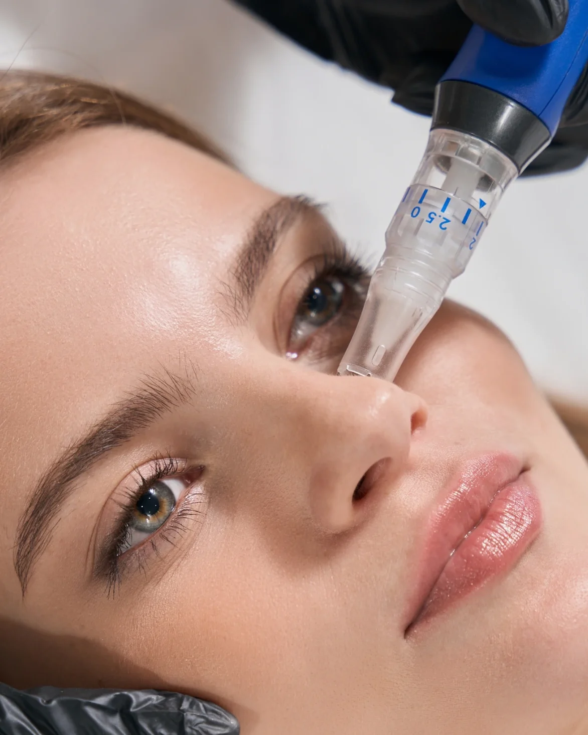 Provider microneedling a patient's cheek before applying peptides and exosomes