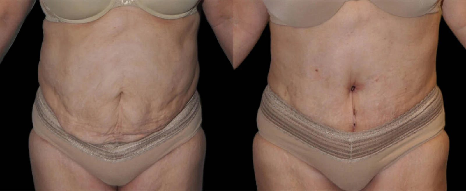 Front view before and after body contouring showing improved abdominal contour and skin tightness